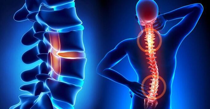 Lokalisierung von Schmerzen bei Osteochondrose