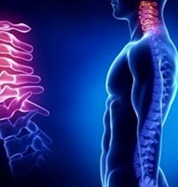 Zervikale Osteochondrose kann durch Verletzungen des Nackens verursacht werden.