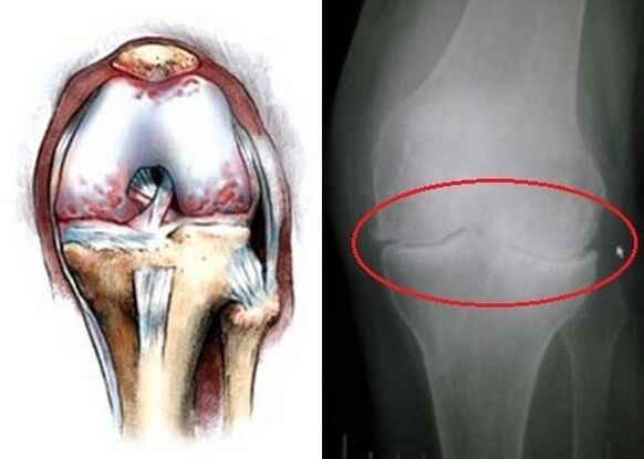 Arthrose des Kniegelenks