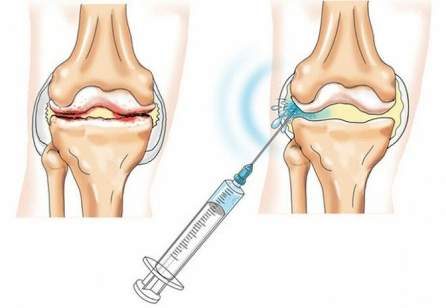 Injektion in das Kniegelenk mit Arthrose