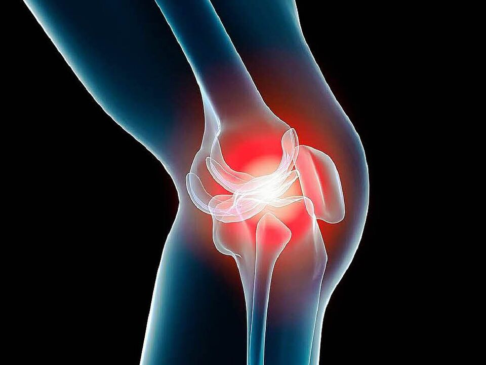 Knie Arthrose